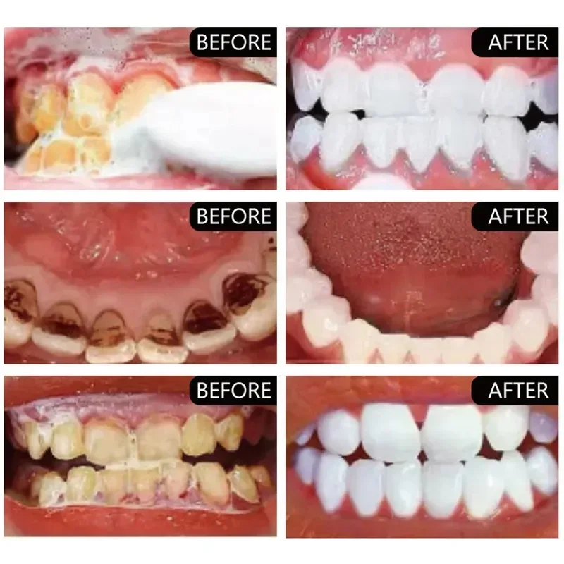 5 Days Teeth Whitening Toothpaste Remove Plaque Stains Powder Deep Cleaning Oral Hygiene Fresh Breath Brightening Tooth Care 50g